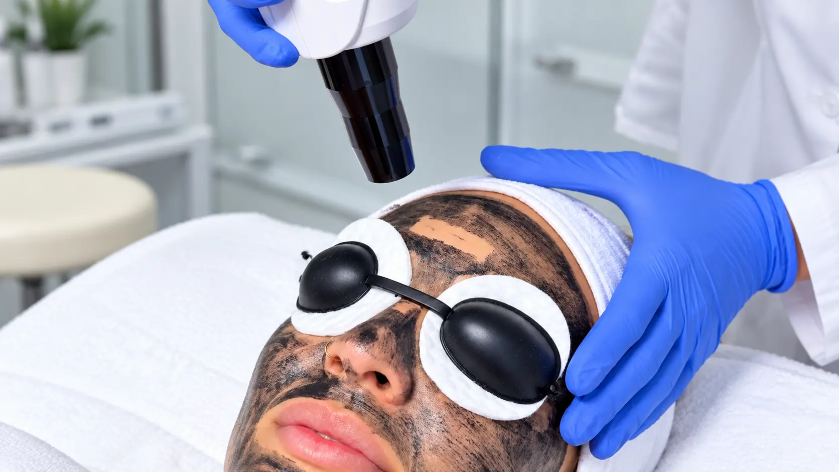 Trattamento Hollywood Carbon Peel con maschera al carbonio, occhiali protettivi e manipolo laser